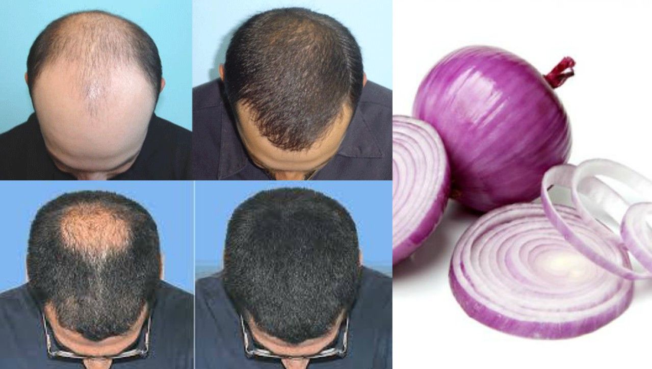 How Onion Juice Can Be Used To Grow Hair And Prevent Baldness – Thav Media